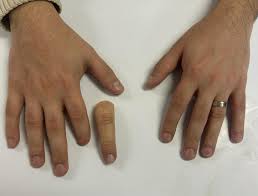 Parmak Protezi - ORTHOGEZ